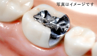 保険適用の銀歯のイメージ画像